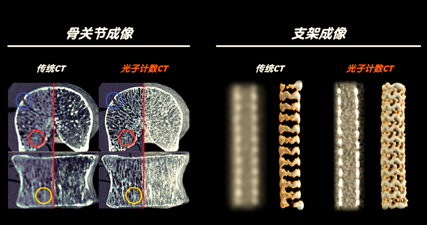 绍兴市人民医院引进全球首款光子计数CT技术