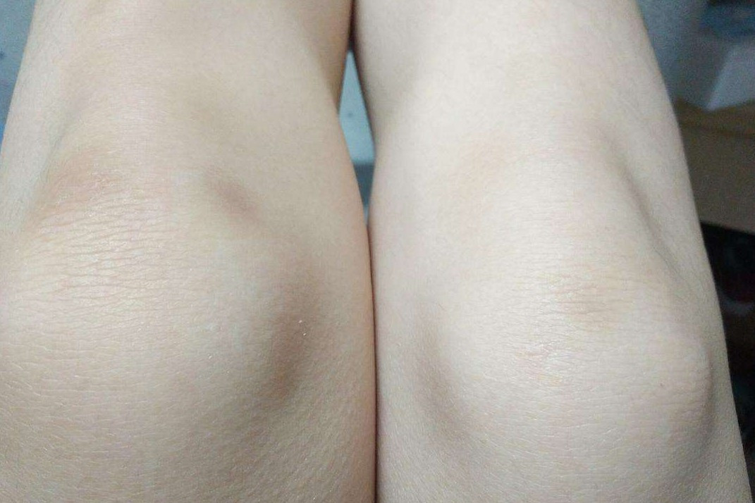 大腿上莫名出现淤青,民间流传是"鬼掐青",医学现已做出解释!