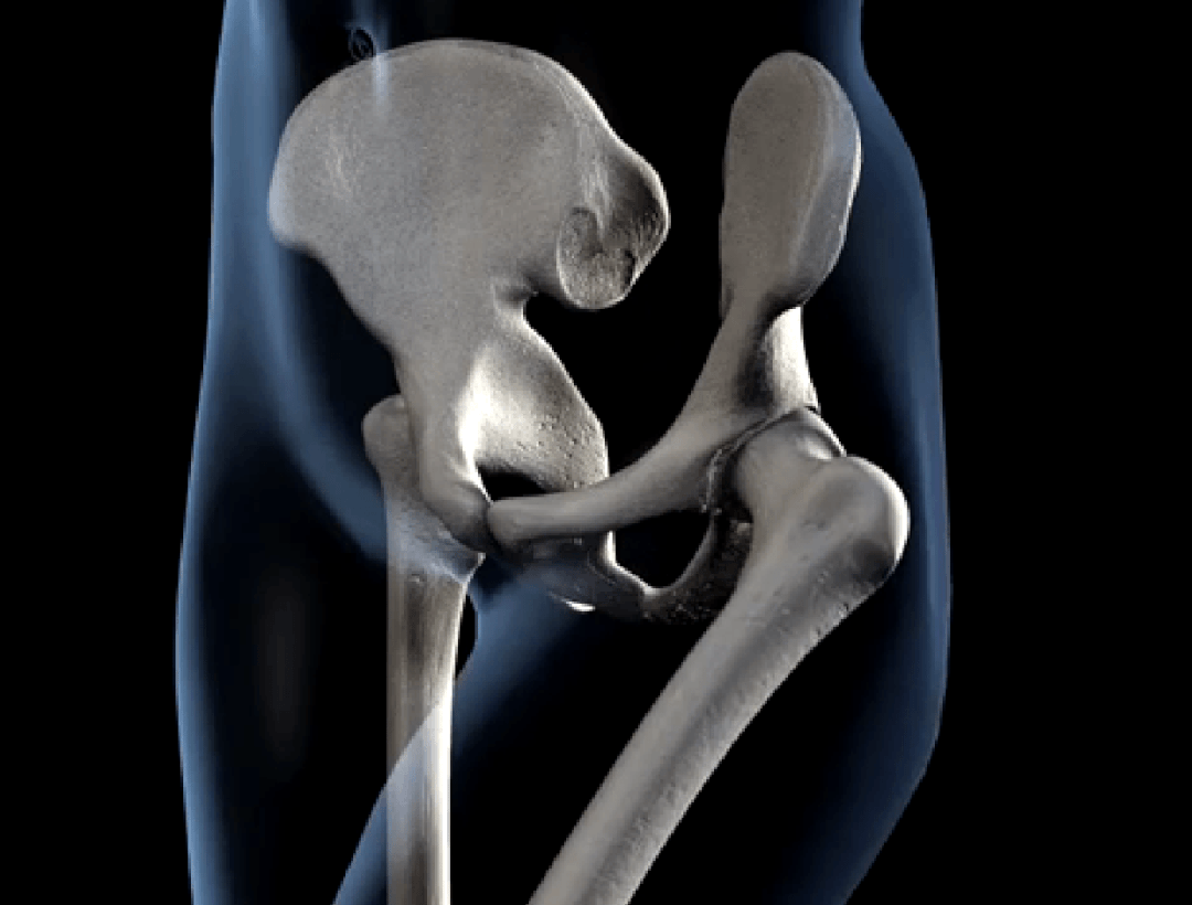 大腿内侧肉多,走路磨大腿?可能不是因为你胖