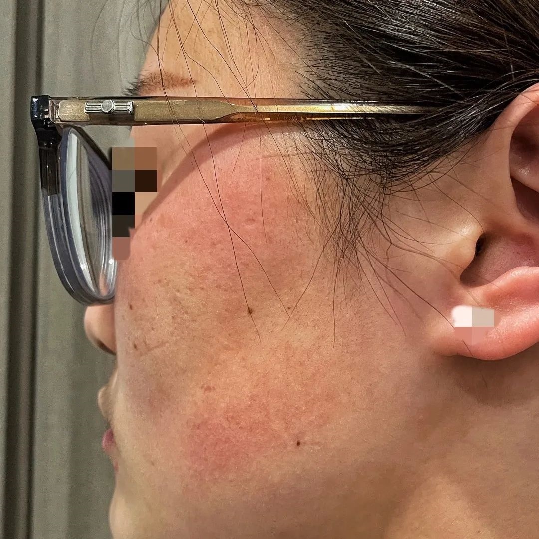 长时间戴口罩脸部过敏了怎么办?