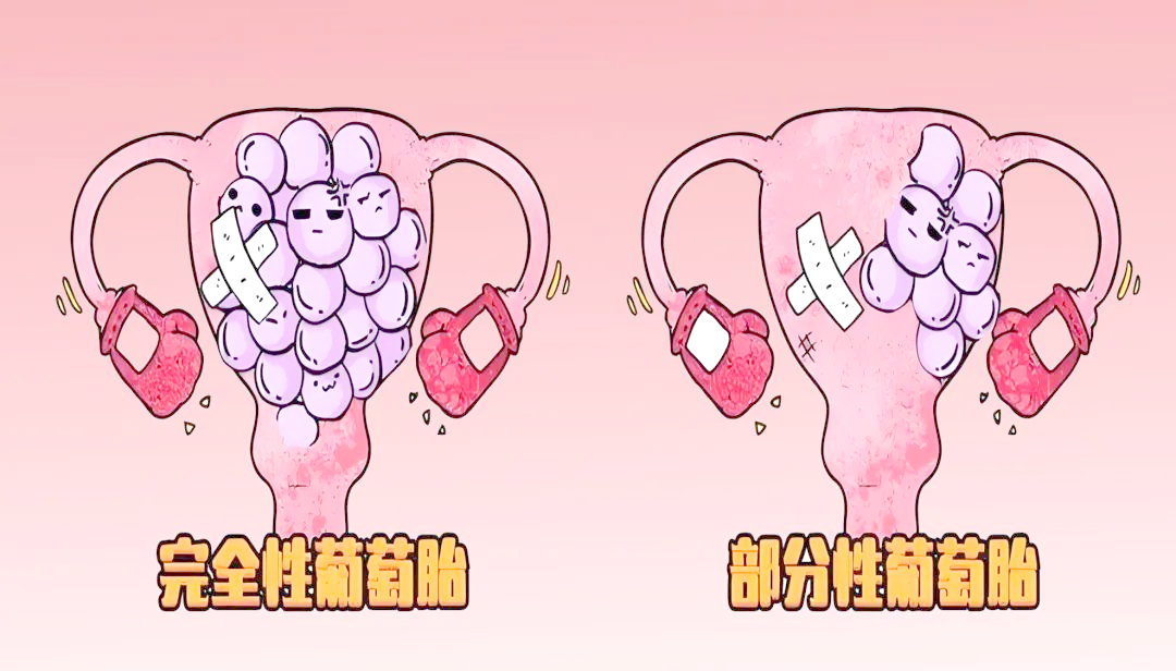 怀孕40天,b超惊现"葡萄"胎儿,葡萄胎现象揭秘