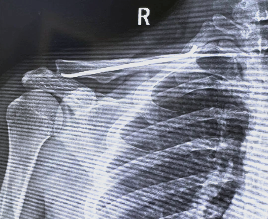 微创技术助力青少年锁骨骨折治疗