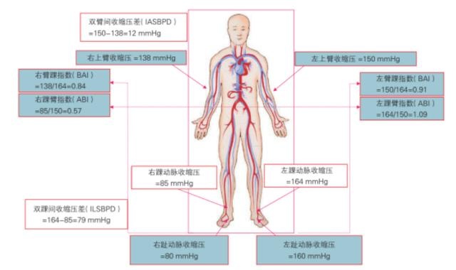 踝肱指数图片