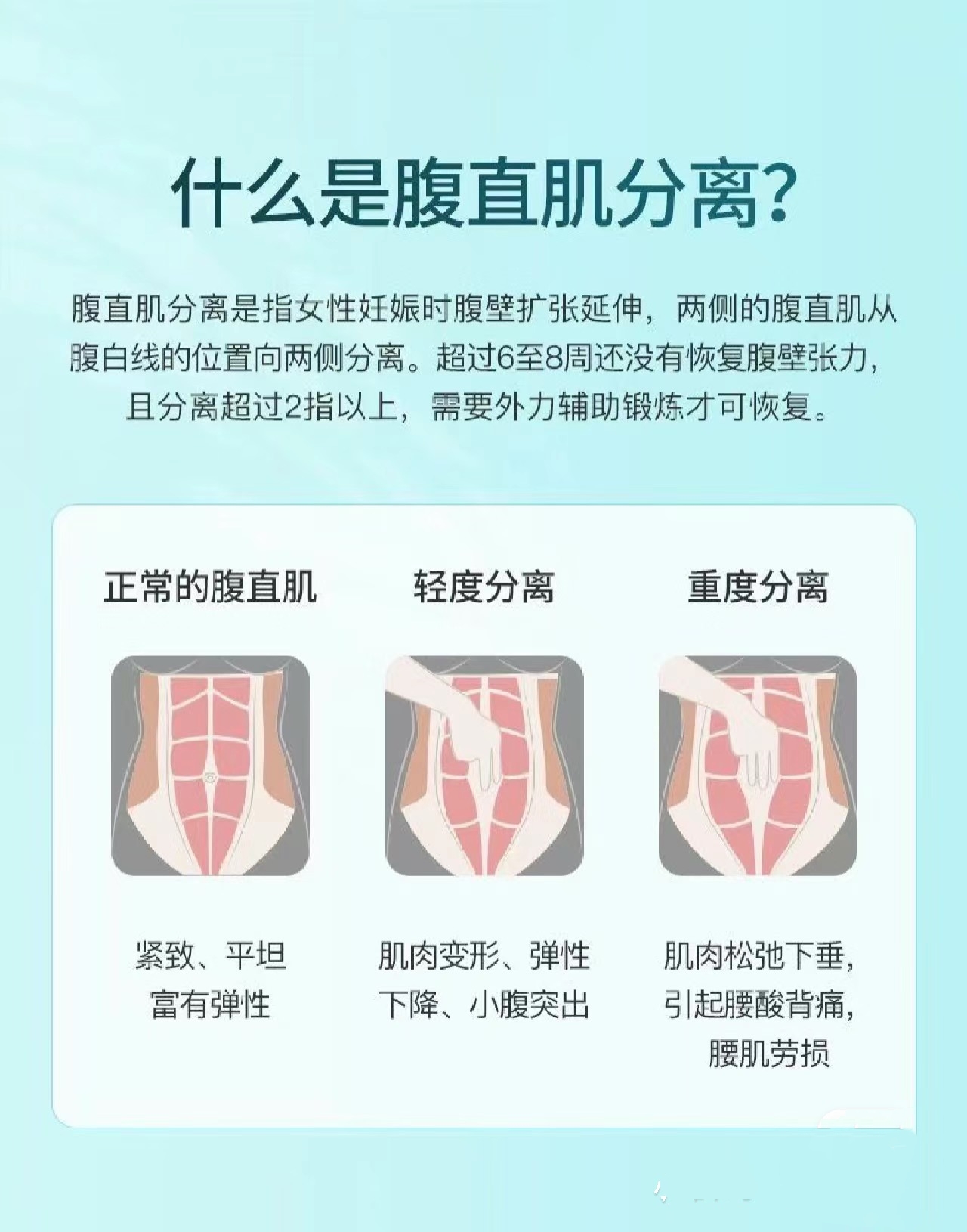 腹直肌分离2指图片