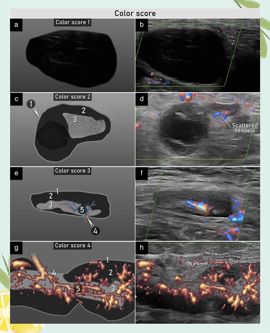 vita共识:描述淋巴结超声特征的术语,定义和测量方法