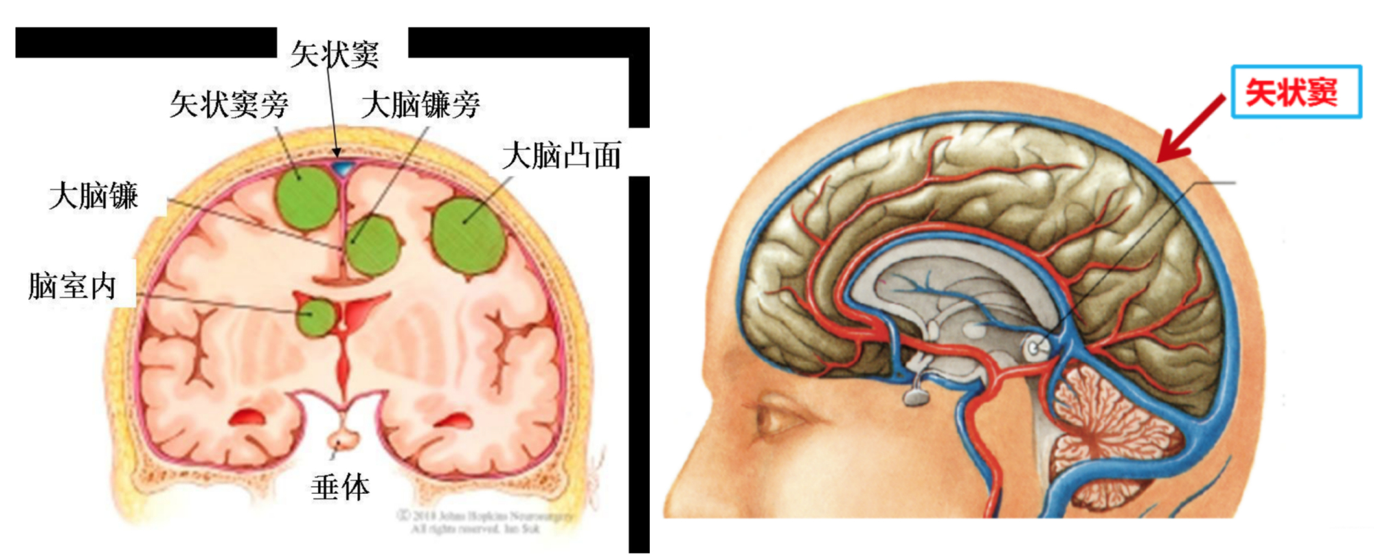 矢状窦旁及大脑镰旁脑膜瘤完全切除手术