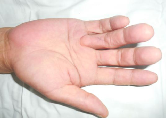 糖尿病的手部早期症状图片