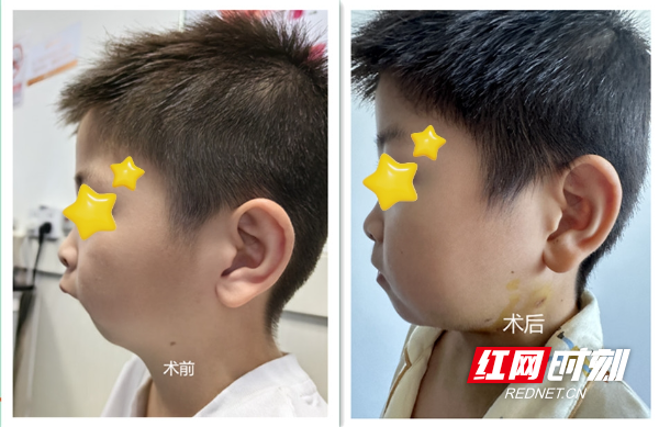 幼童下颌畸形呈"鸟状"面容 湖南省儿童医院手术再造下巴