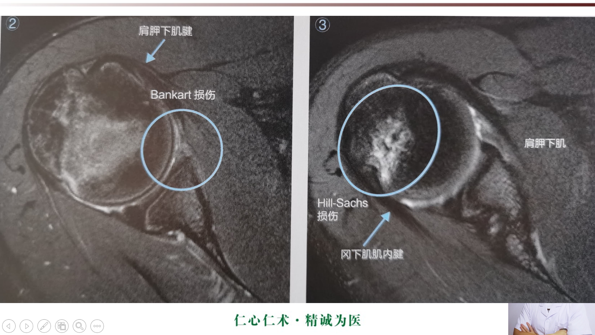 盂肱韧带mri解剖图片