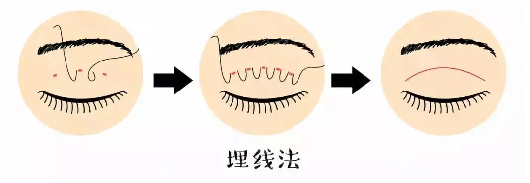 双眼皮有几种术式?埋线,三点小切口,全切,你适合哪种?