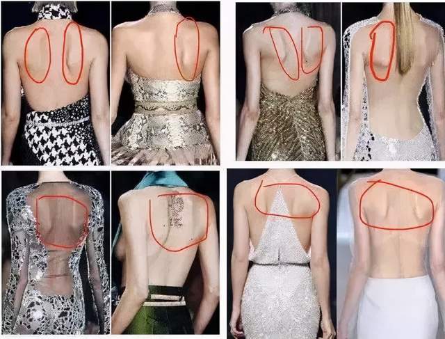 女性"蝴蝶肩"一个美丽的谎言,如何康复治疗?(一)