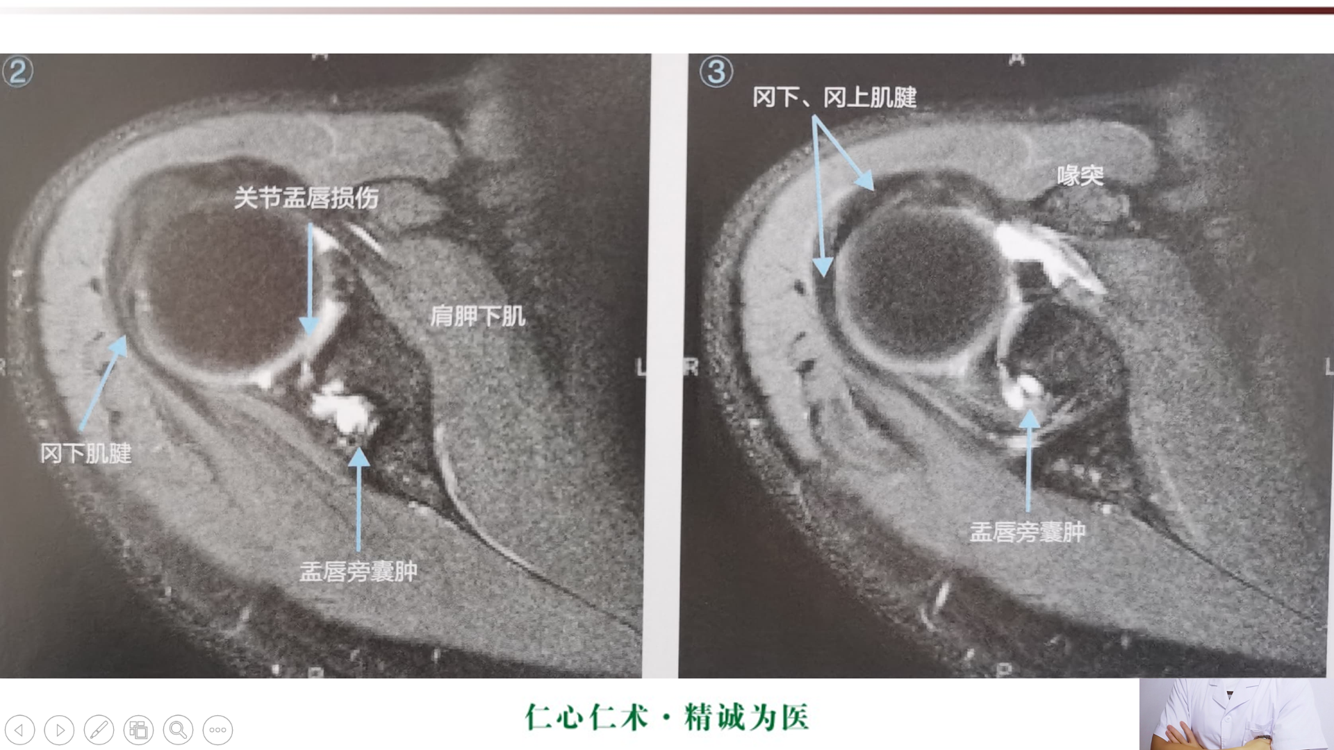 盂肱韧带mri解剖图片