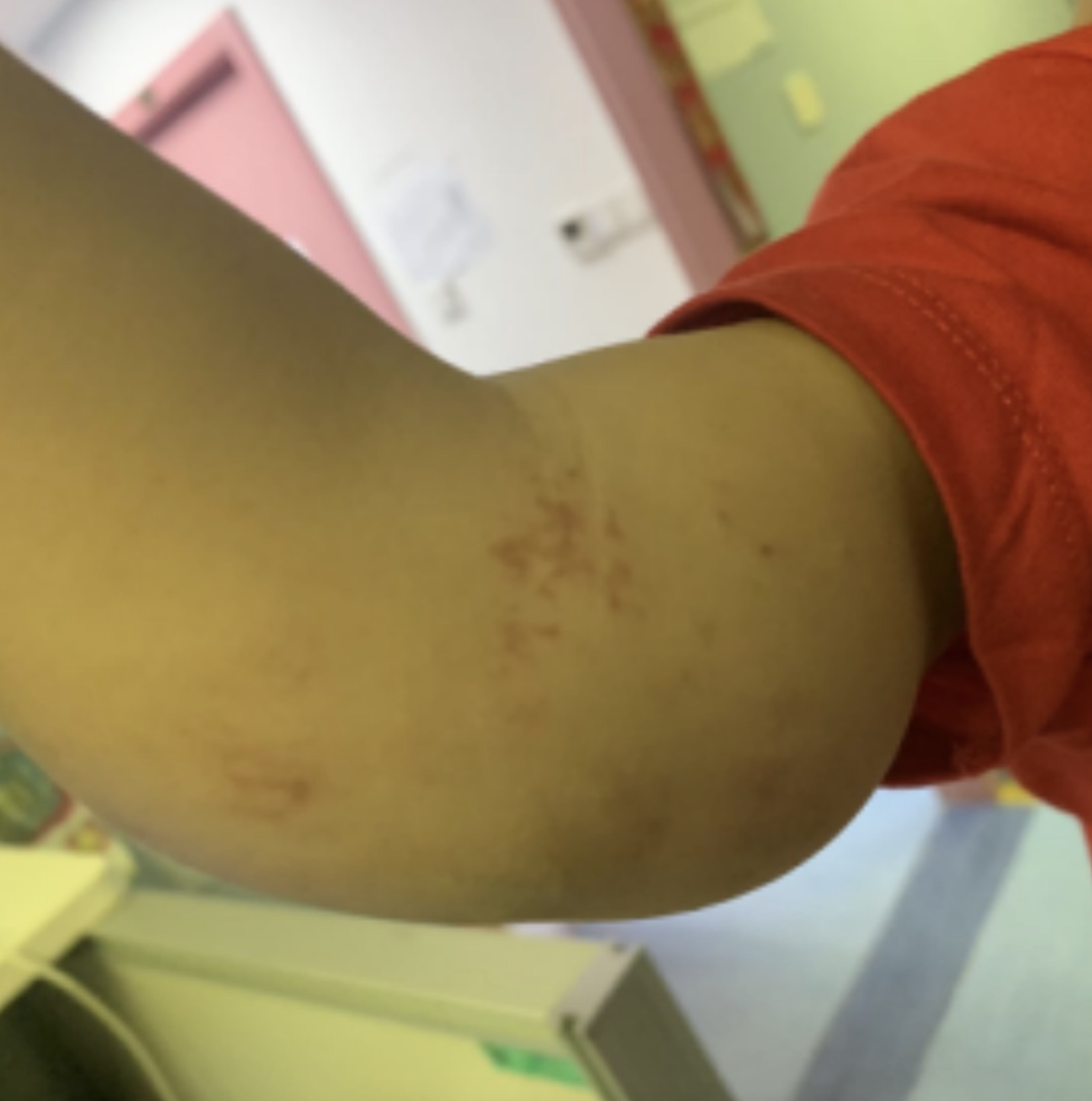 右肘部微囊型淋巴管瘤介入治疗案例