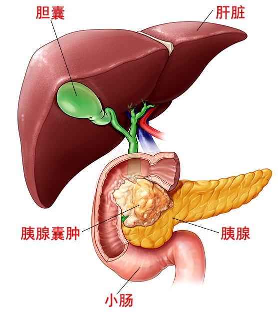 三十岁女性遇上胰头巨大肿瘤,传统手段可能损伤多个器官,绝境之中迎来