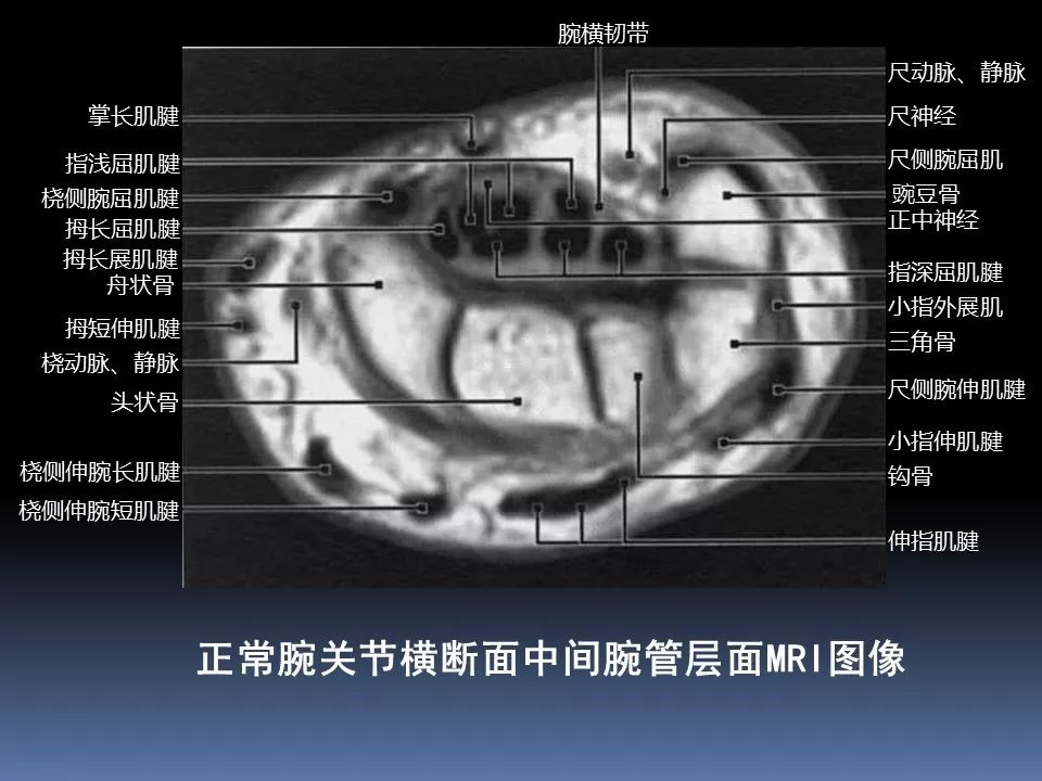 「影像解剖」腕关节的mri解读!