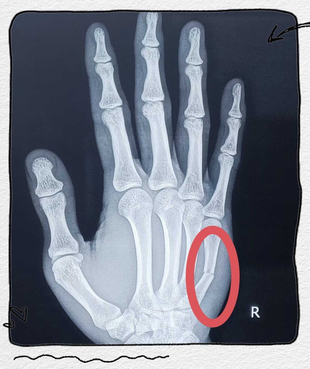微创手术——闭合复位钛针固定术,治疗掌骨骨折的新选择