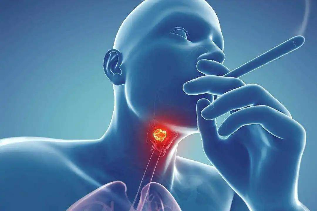 喉癌和咽炎的区别图片图片