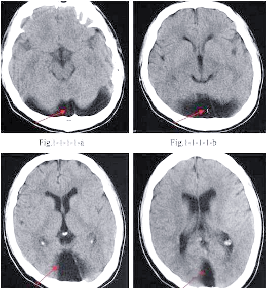 大枕大池及其鉴别诊断详解