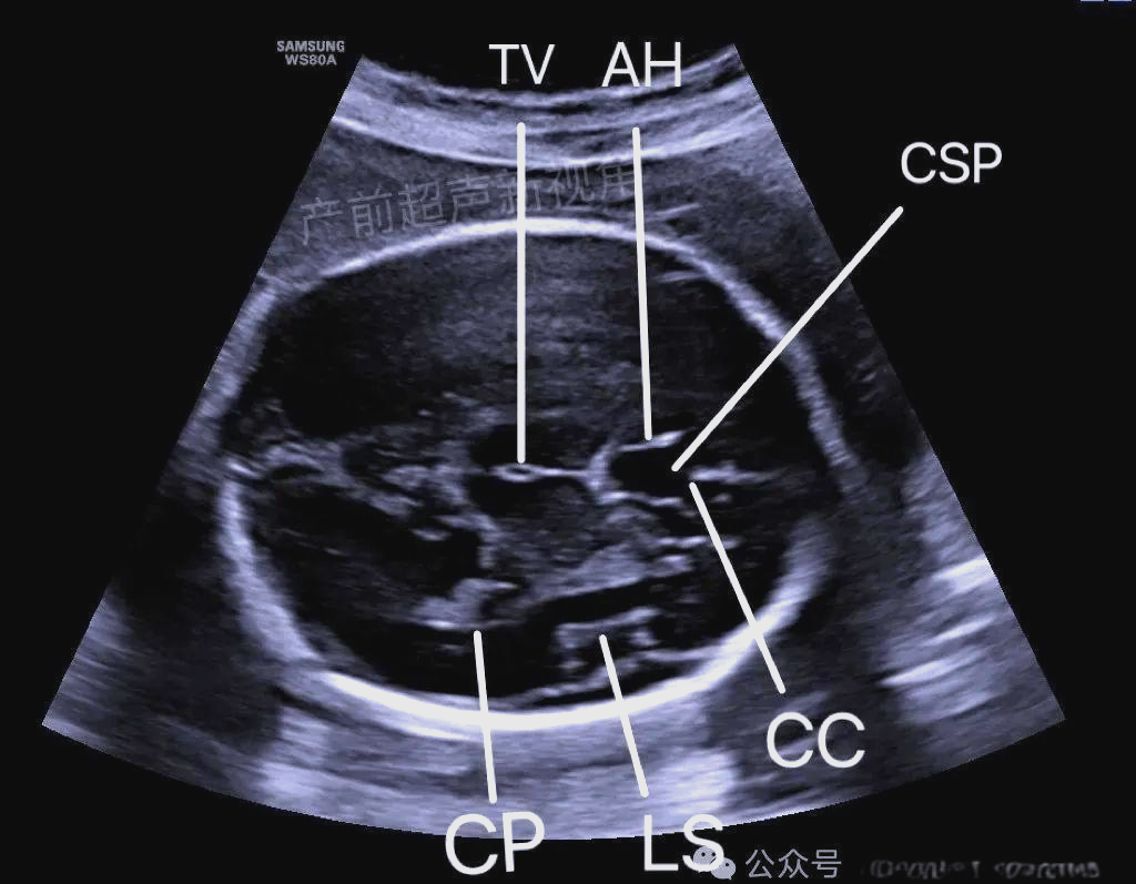胎儿透明隔腔异常的超声表现及诊断