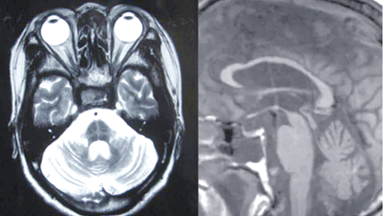 大枕大池及其鉴别诊断详解