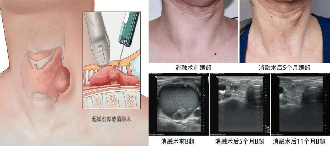 甲状腺消融术的副作用