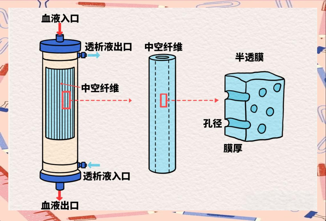 血液透析的核心部件是血液透析器,通常被称为"人工肾",其内部结构包含