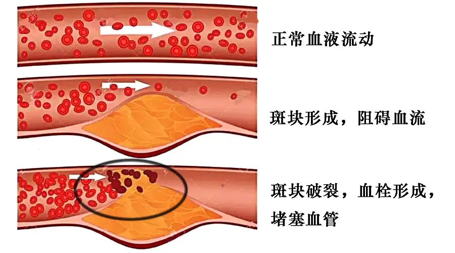 血栓和斑块的区别图片