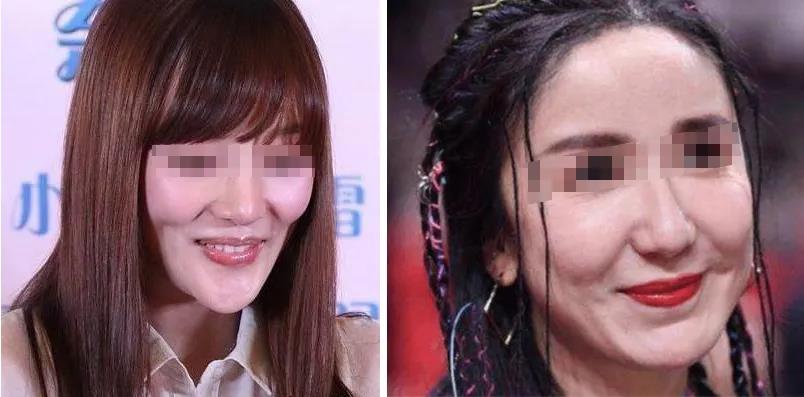 填充玻尿酸会导致苹果肌下垂?念自然带你揭秘真相!