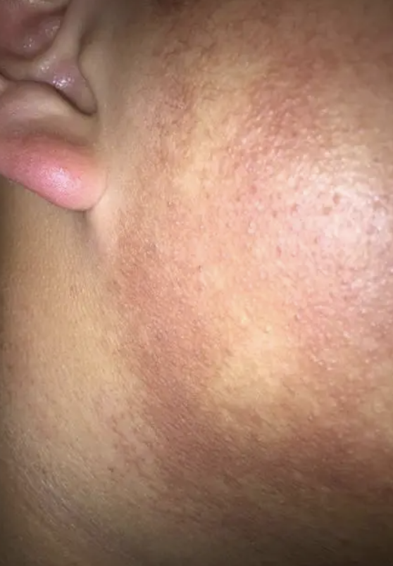皮肤角质层薄怎样加速修复