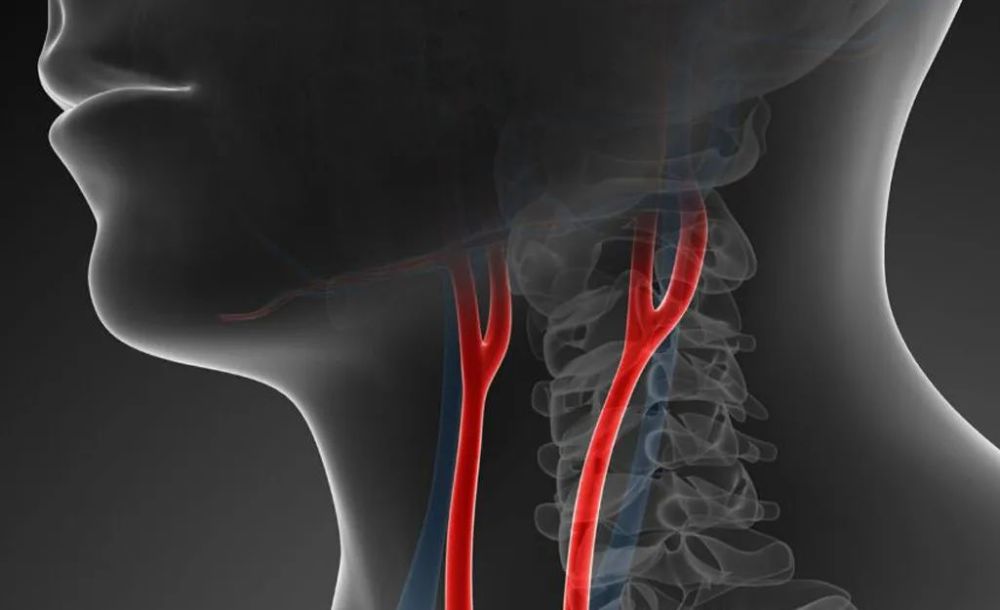 颈动脉为何容易形成斑块,导致堵塞?