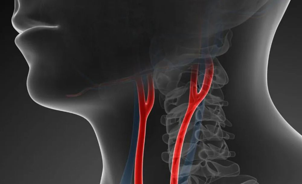 颈动脉充盈图片