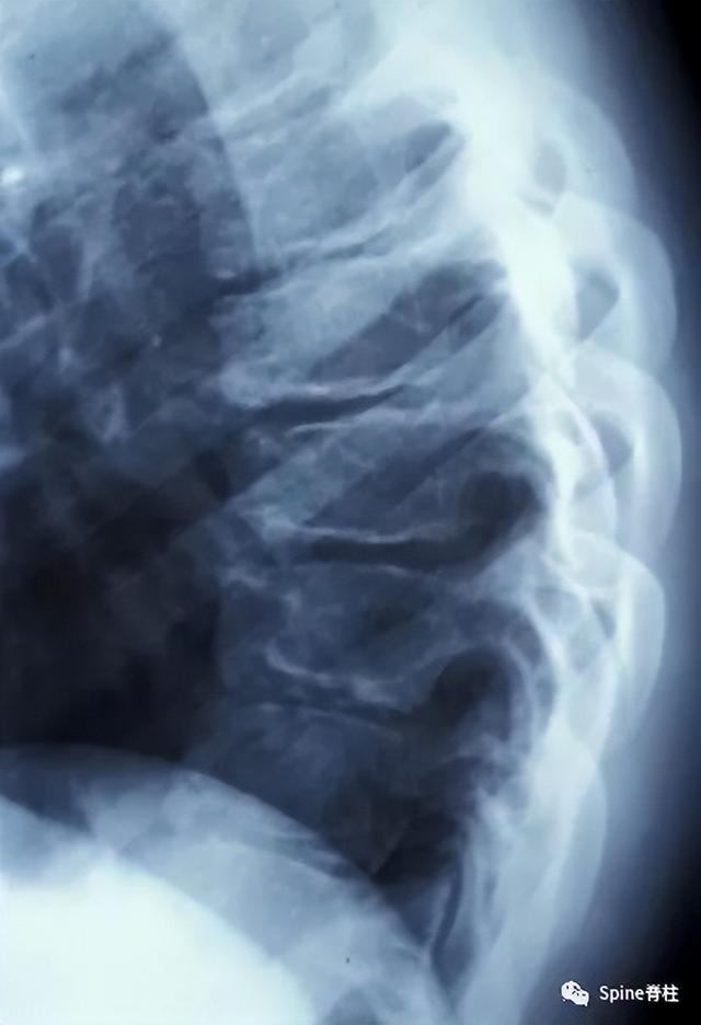 scheuermann病(休门氏病)