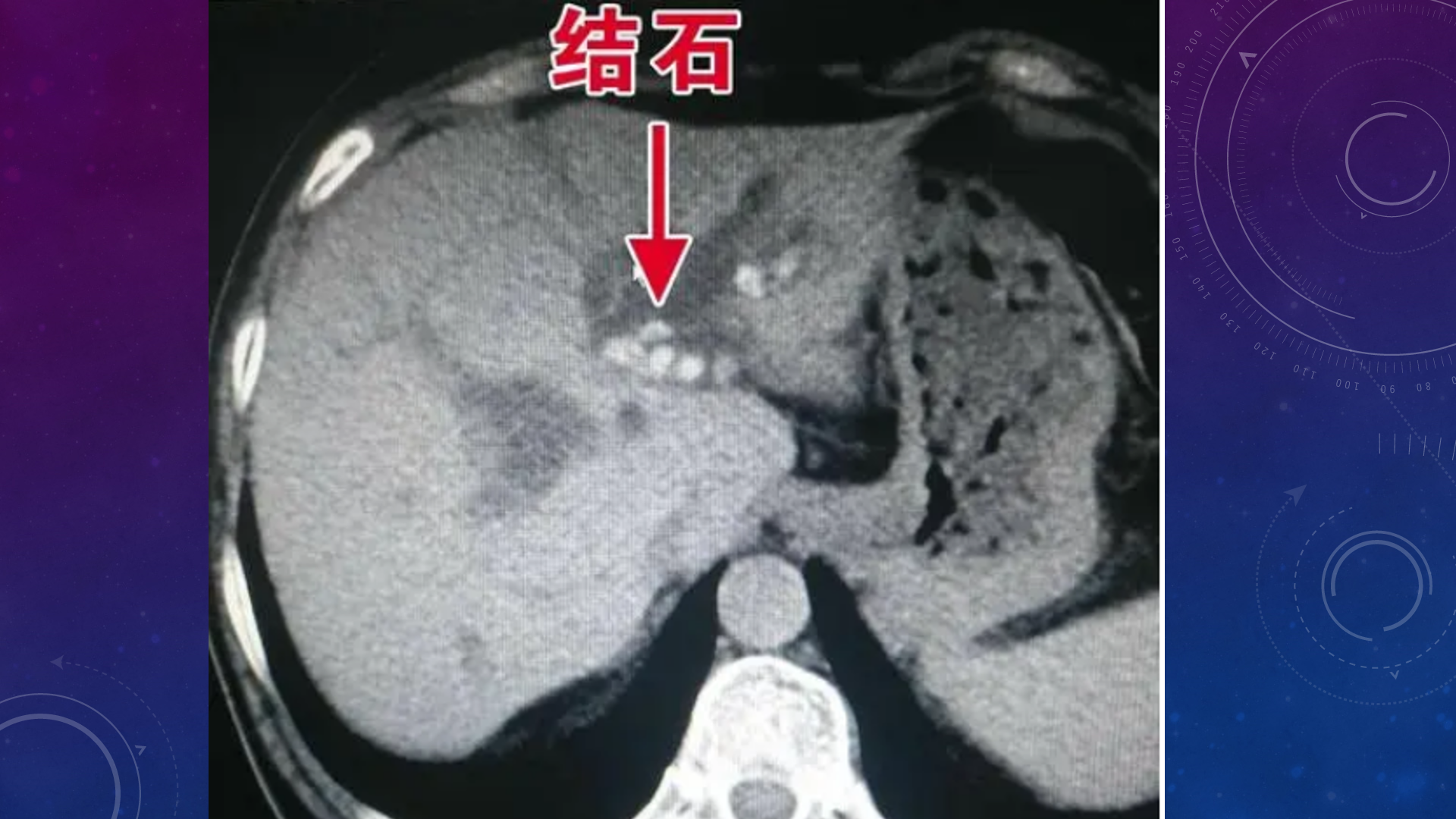 急腹症影像:胆道结石ct表现!