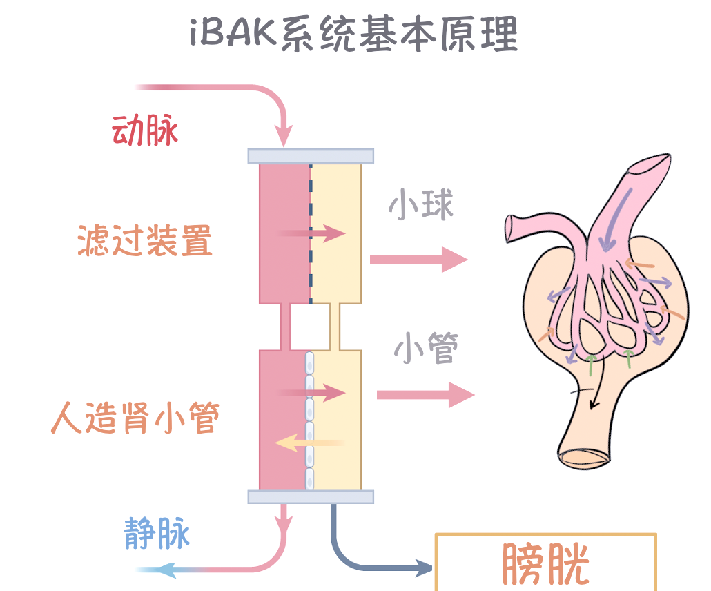 人工肾技术的新突破:植入式人工肾的研发与挑战