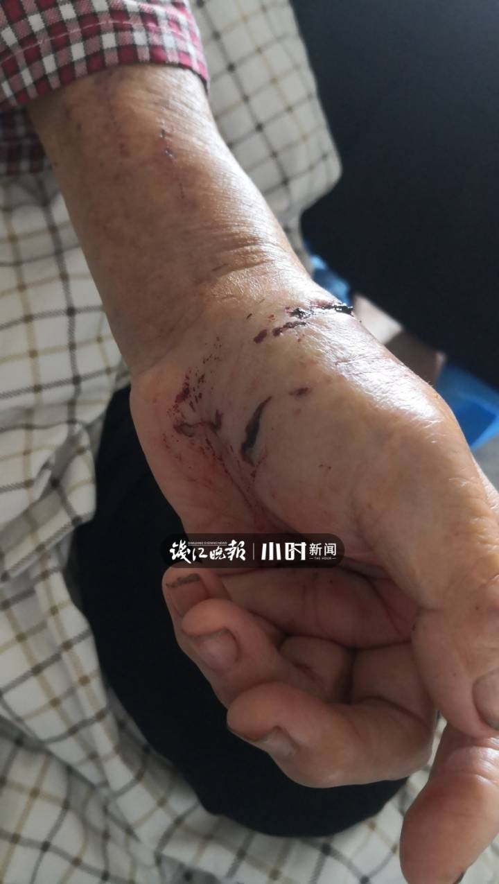 临安西部山村,老妇被神秘动物咬成重伤;有村民说,可能是狼或豺