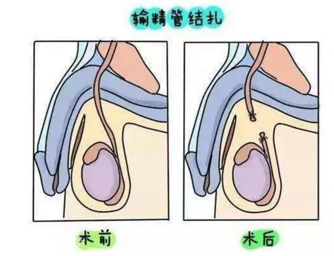 男性结扎会影响生殖功能吗?