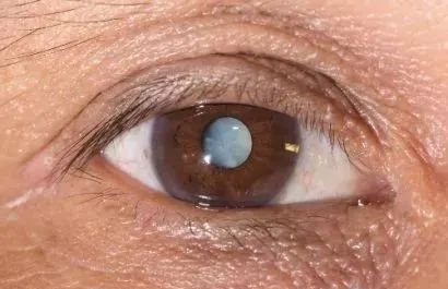 手术后"白内障复发" 人工晶体也会浑浊吗?