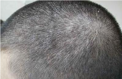 男生头痒头皮屑特别多怎么去除?花诉妍去屑止痒控油!