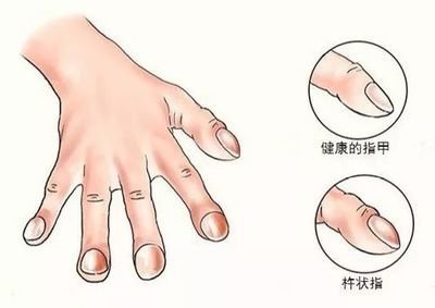 右为杵状指)郑俊猛教授介绍,杵状指有一种较简单的自测方法——scham