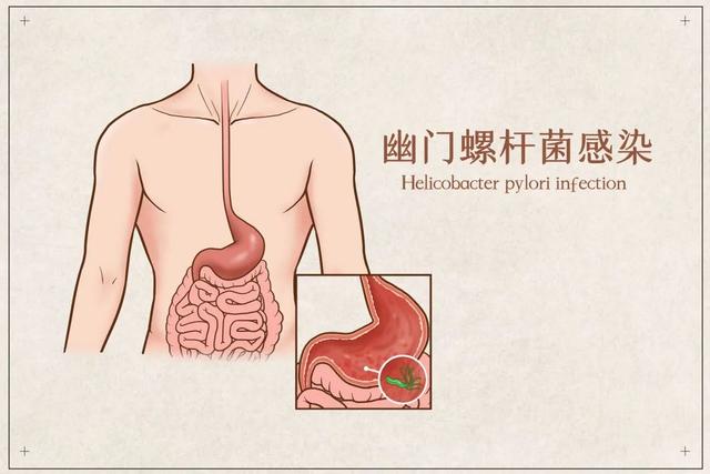 “明确致癌物”幽门螺杆菌,究竟该怎么防?