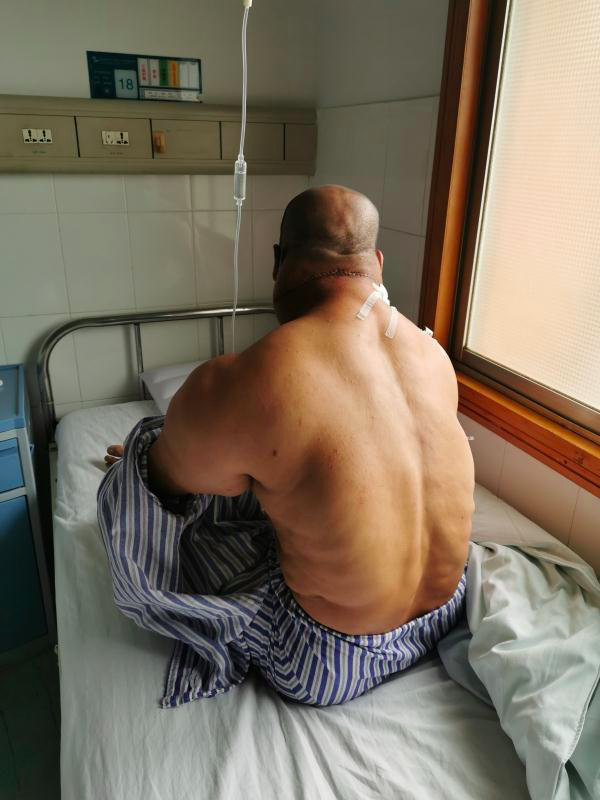 男子脂肪狂长堆成"绿巨人",原来患上全球罕见"马德龙病"