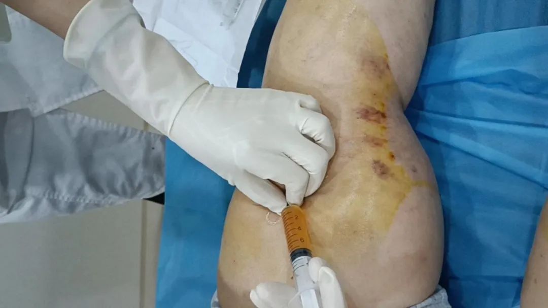 老年人膝关节积液不要随便抽,搞清楚再说!