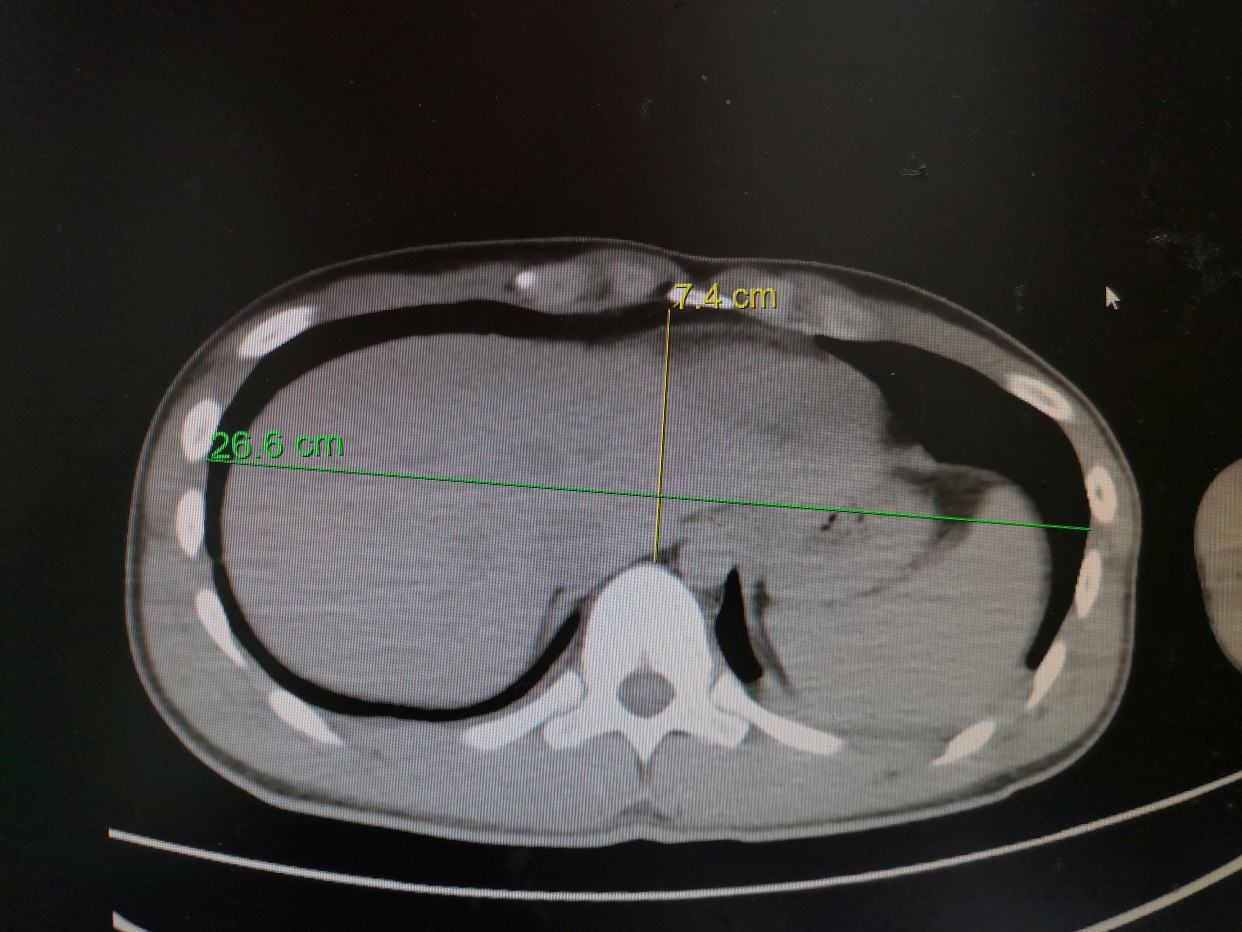 需要手术吗?怎么样知道漏斗胸需不需要手术?