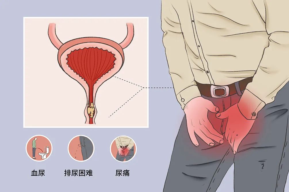 男性得了尿路结石该怎么办?这6种治疗方法能帮到你!