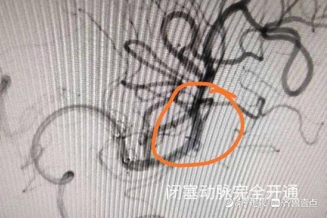 宁阳一女子突发脑梗无法下床,在县一院治疗两周实现独立行走