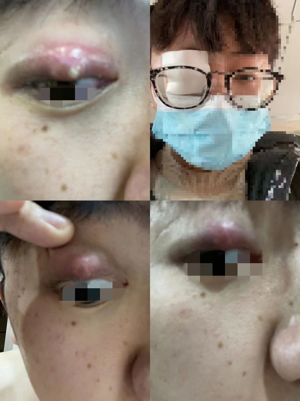 男子泡汤后眼睛红肿确诊麦粒肿,称是水质不干净导致,店家:要有证据