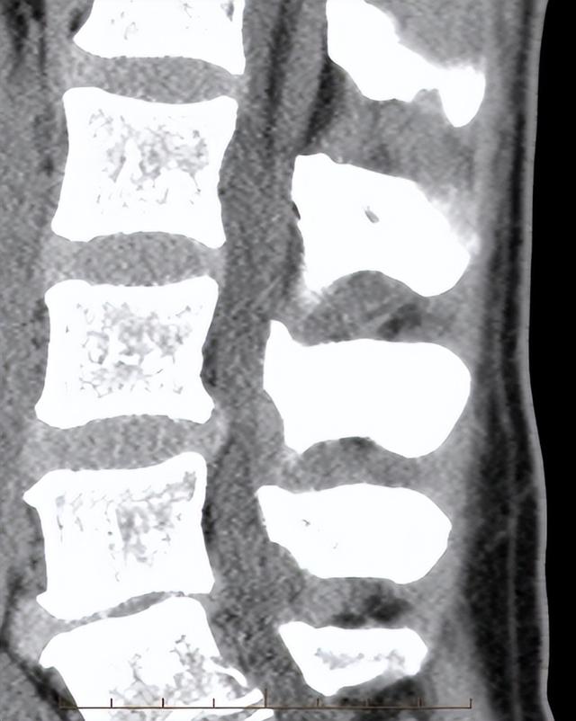 终丝脂肪沉积(fatty filum terminale)