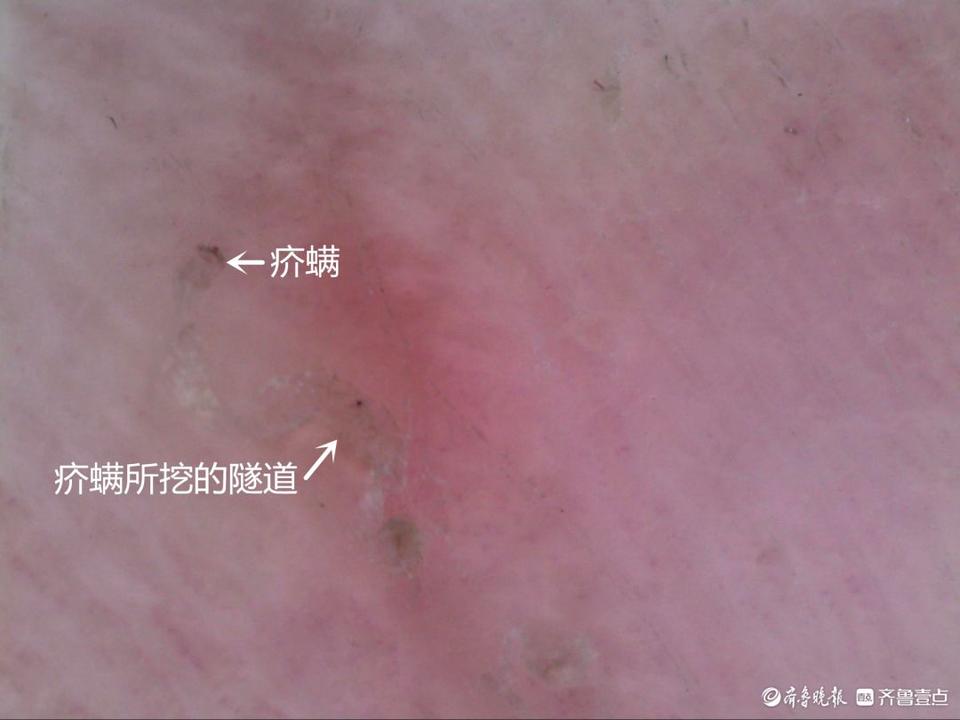 烟台4岁男童浑身奇痒难耐,反复用药不见好转!一查竟是疥疮作祟