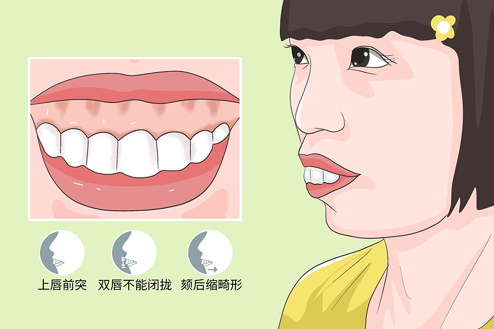 长沙龅牙要做牙齿矫正吗?