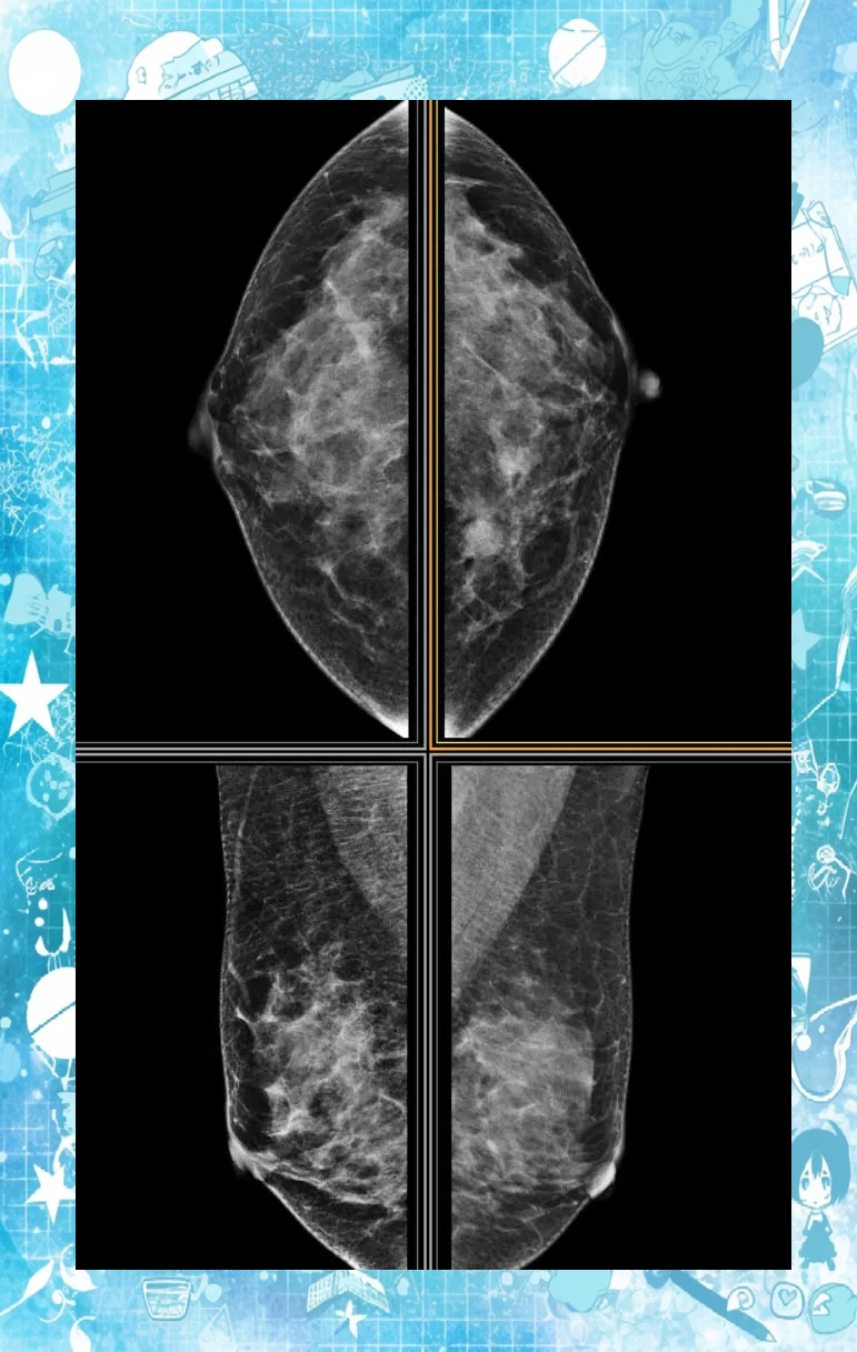 乳腺癌影像筛查方法全解析